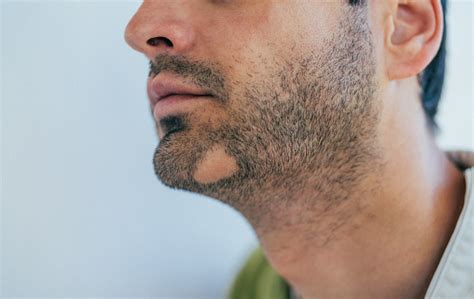 sakal kıran tedavisinde kullanılan ilaçlar